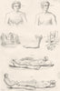 ANATOMY. Dislocations 1880 old antique vintage print picture