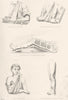 MEDICAL. Fractures; Fore Arm; above Elbow; thigh; Splints; Collar bone 1880