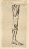 A Man's Leg, fractured in an extraordinary manner. Gentleman's Magazine 1769