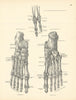 Anatomy. Right Foot Bones, 4th & 5th Toes, Ligaments 1880 old antique print