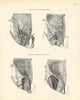 Anatomy. Inguinal & Femoral Hernia Topography 1880 old antique print picture